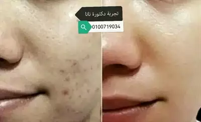  صورة 6 تراكيب التفتيح الآمن والنورة الخرافية من Dr Nana c