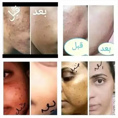  صورة 7 تراكيب التفتيح الآمن والنورة الخرافية من Dr Nana c