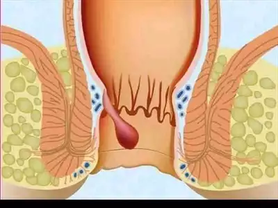  صورة 1 اليوم يمكنك التخلص من البواسير