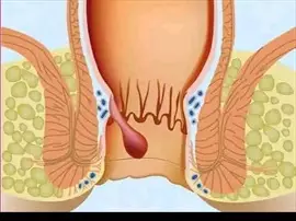 صورة - اليوم يمكنك التخلص من البواسير